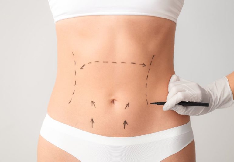 Abdominoplastia