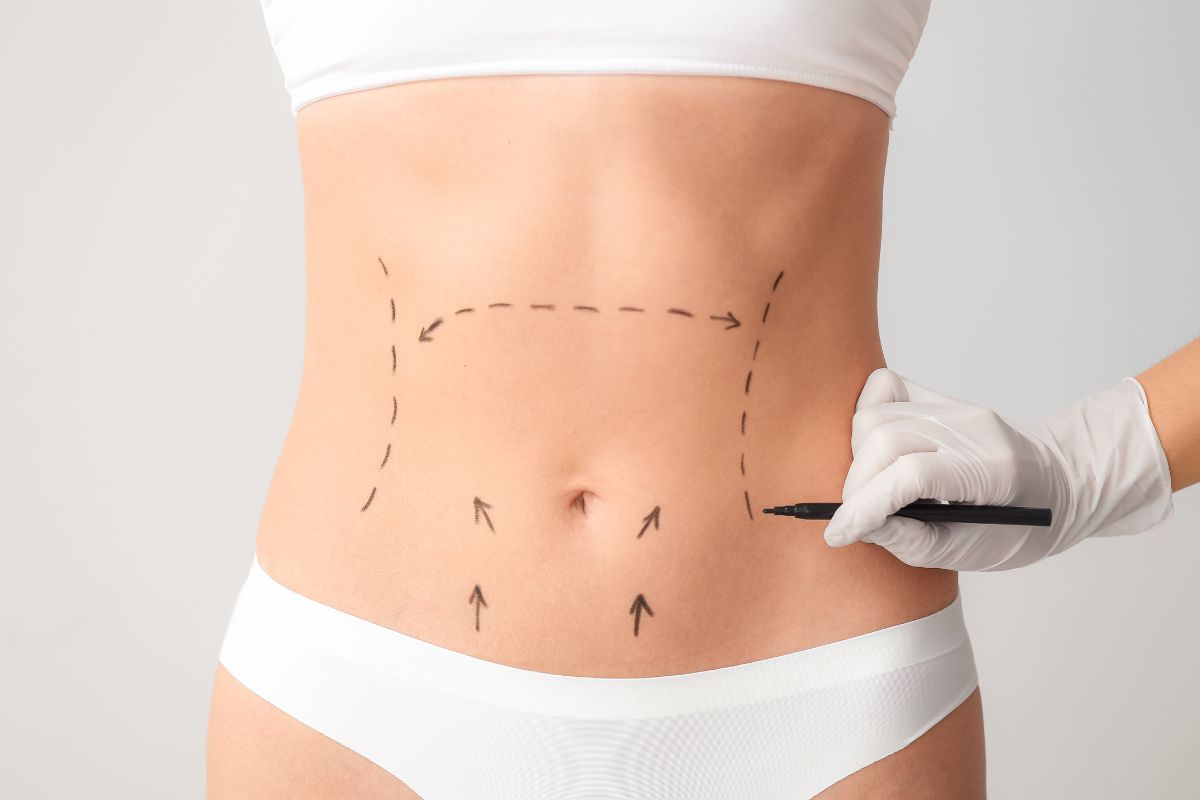 Abdominoplastia