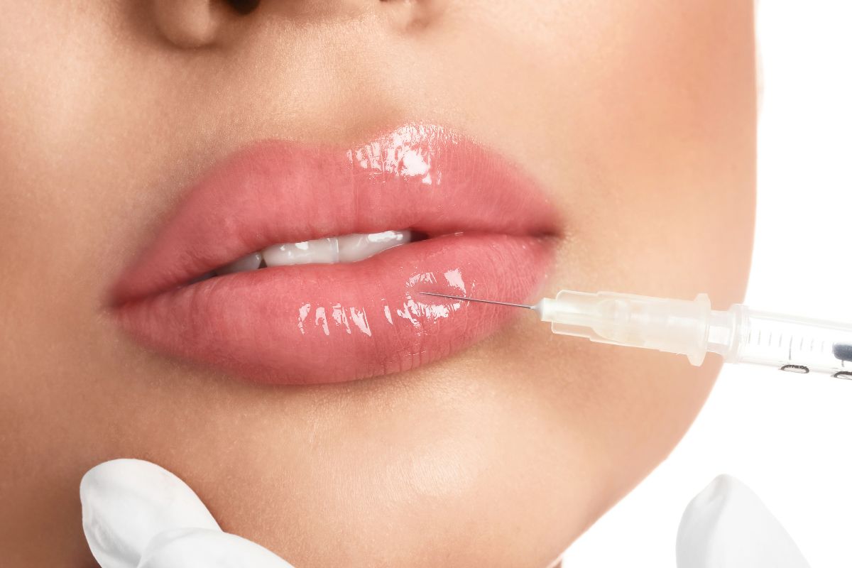 Relleno de labios con acido hialuronico